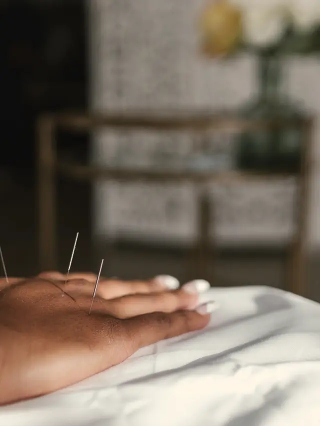A physician's hand resting beside fine acupuncture needles placed on the back of a patient's hand